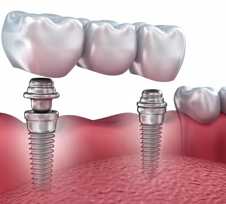 Puente-dental-sobre-implante Puente dental sobre implante en Clínica Dental San Manuel Puebla