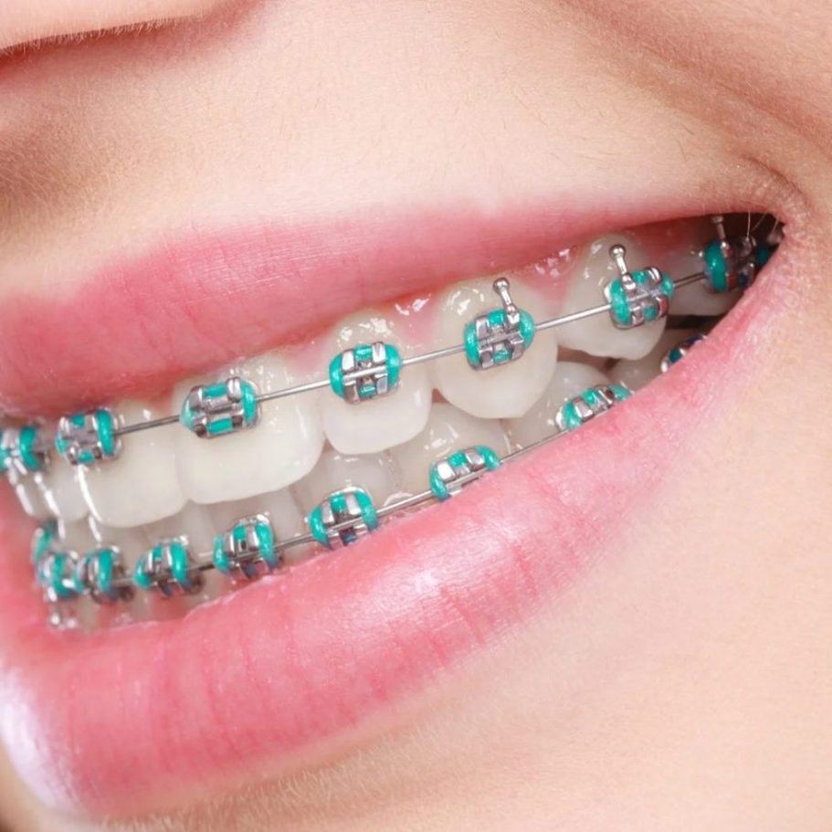 Ortodoncia Puebla | Lumident clínica dental | Dentistas Puebla