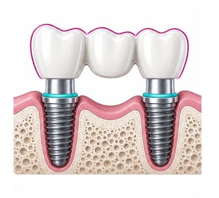 Puente-dental-sobre-implante Puente dental sobre implante en Clínica Dental San Manuel Puebla