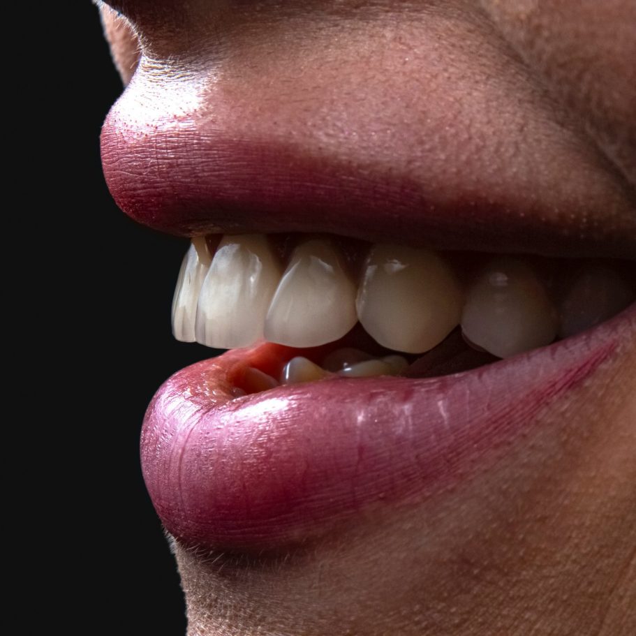 Implantes dentales Puebla | Lumident Clínica Dental | Dentista Puebla