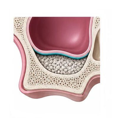 elevacion-seno-maxilar-puebla Especialista en elevación de seno maxilar para implantes dentales en San Manuel.