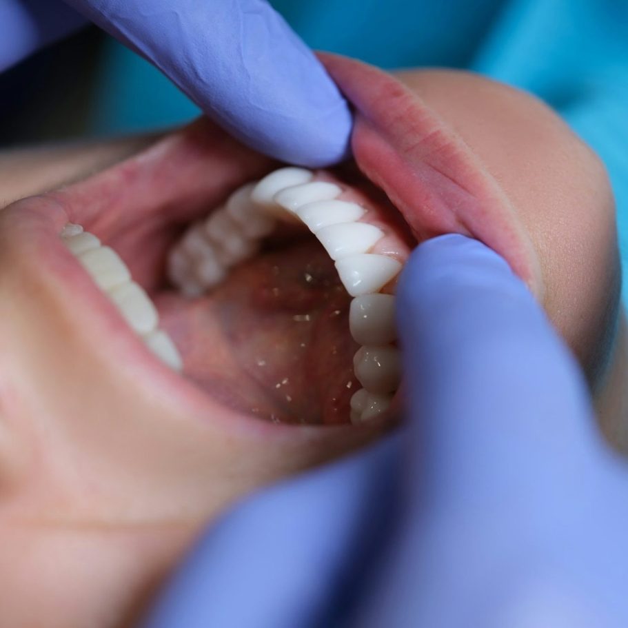 Prótesis dentales Puebla | Lumident clínica dental | Dentistas Puebla